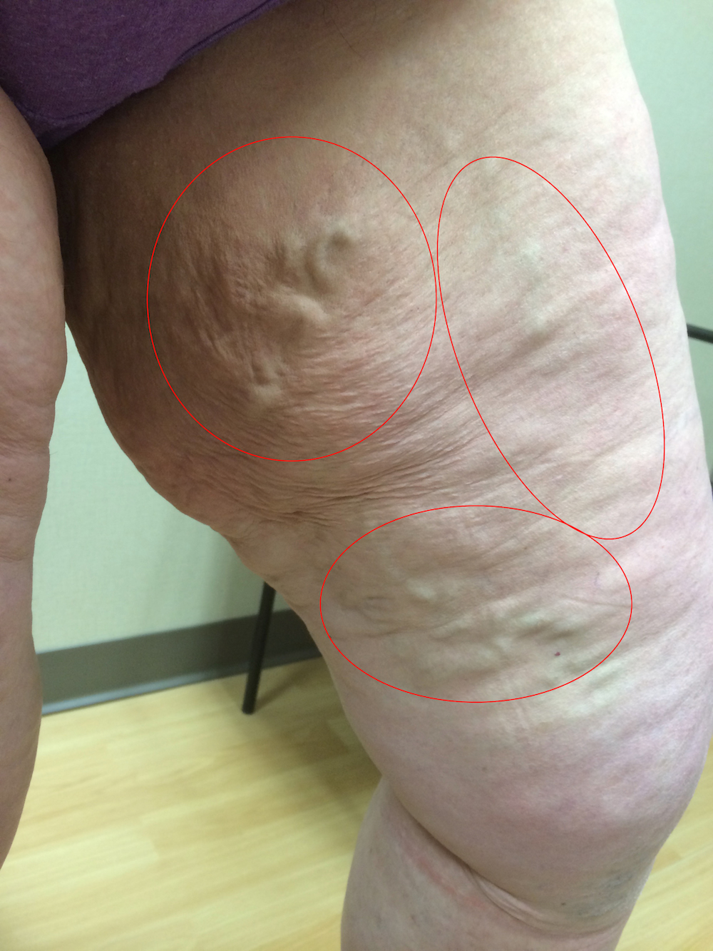 Venous Insufficiency for Griffin, Atlanta and McDonough, GA