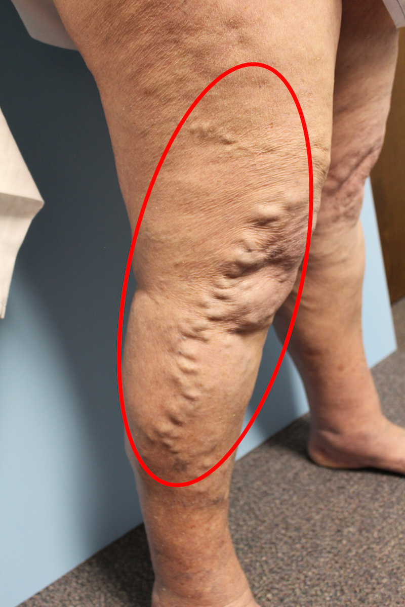 Symptoms of Venous Insufficiency - Delaware Vein Center